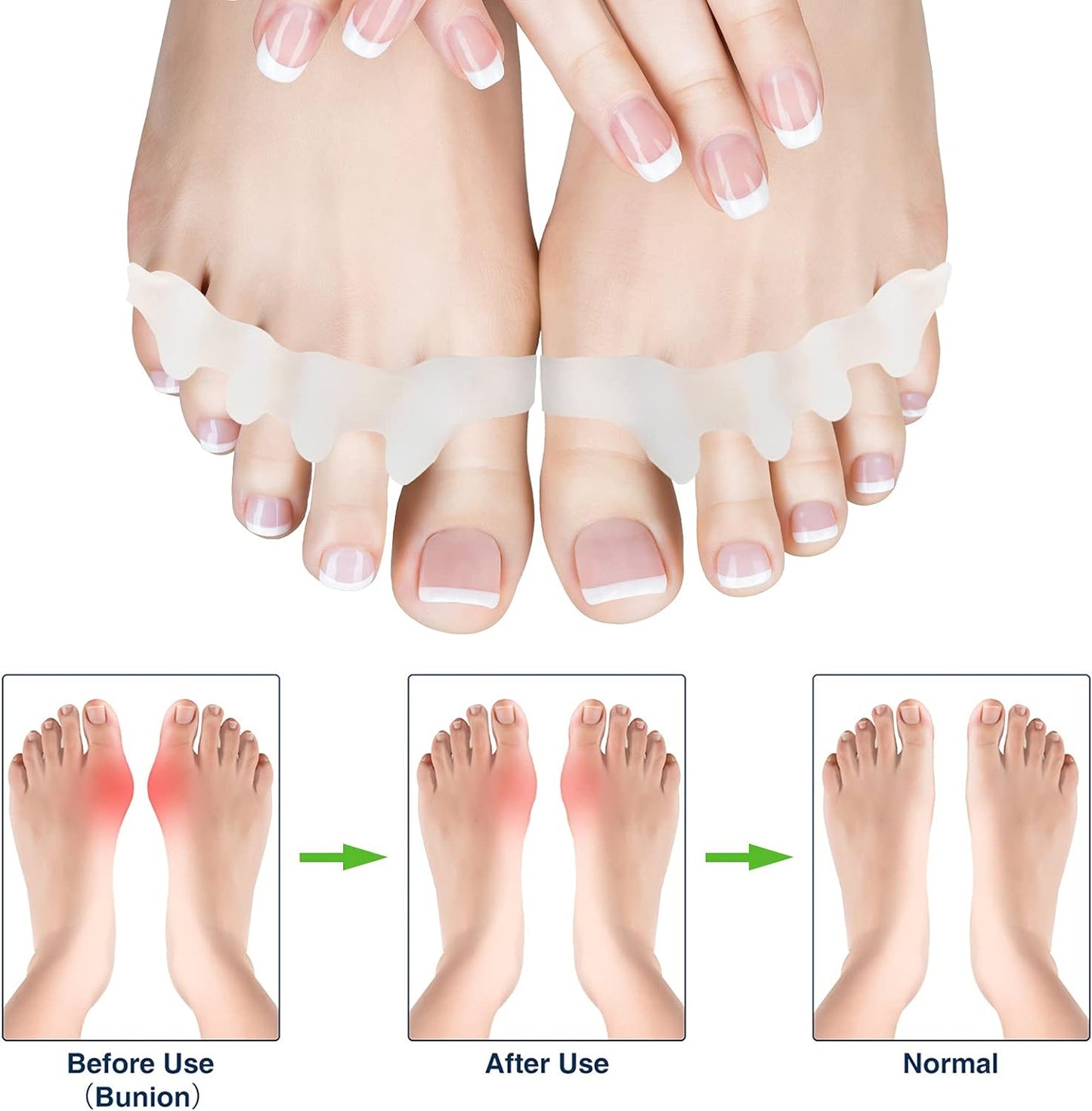 5-Toe Silicone Separator Pads – Orthopedic Bunion Corrector & Overlapping Toe Pain Relief